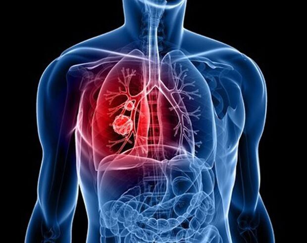 Παράσιτα στους πνεύμονες